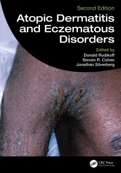 Atopic Dermatitis and Eczematous Disorders