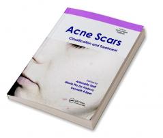 Acne Scars