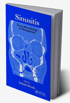 Sinusitis