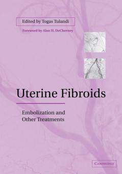 Uterine Fibroids