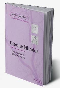 Uterine Fibroids