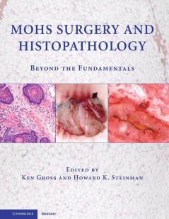 Mohs Surgery and Histopathology
