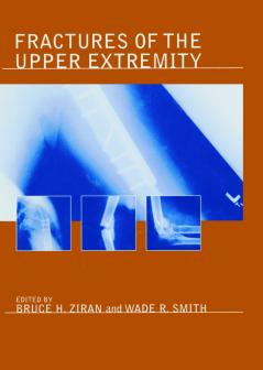 Fractures of the Upper Extremity