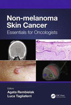 Non-melanoma Skin Cancer