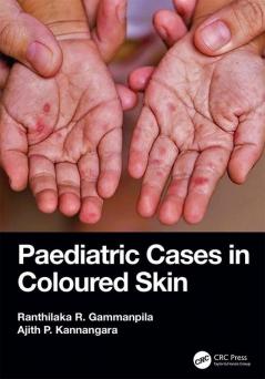 Paediatric Cases in Coloured Skin