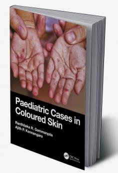 Paediatric Cases in Coloured Skin