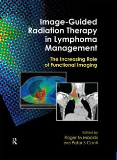 Image-Guided Radiation Therapy in Lymphoma Management