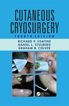 Cutaneous Cryosurgery