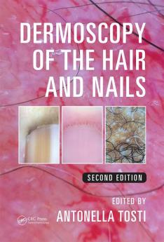 Dermoscopy of the Hair and Nails