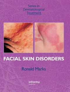 Facial Skin Disorders