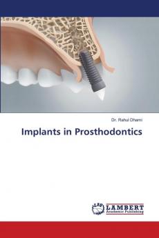 Implants in Prosthodontics