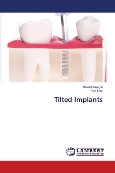 Tilted Implants