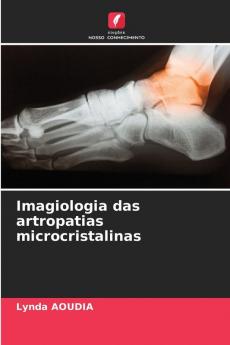 Imagiologia das artropatias microcristalinas