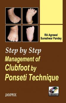 Step by Step Management of Clubfoot by Ponseti Technique (with DVD-ROM)