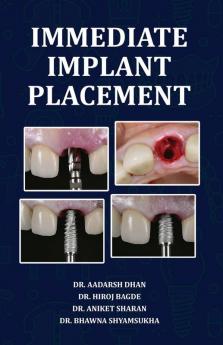 Immediate Implant Placement