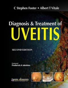 Diagnosis & Treatment Of Uveitis