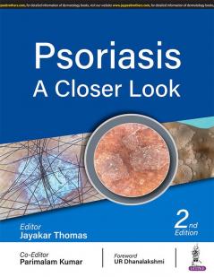 PSORIASIS: A CLOSER LOOK