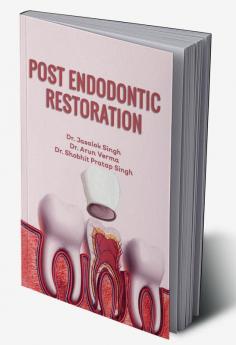 Post Endodontic Restoration