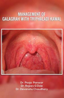 Management of Galagrah with Triphaladi kawal