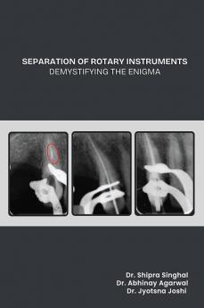 Separation of Rotary Instruments Demystifying The Enigma