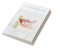 Overdenture