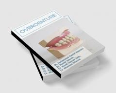 Overdenture