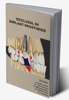 OCCLUSAL IN IMPLANT PROSTHESIS