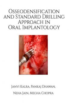 Osseodensification and Standard Drilling Approach in Oral Implantology