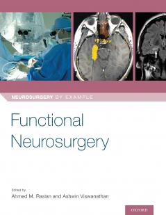 Functional Neurosurgery