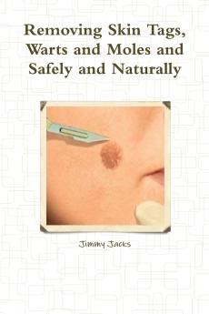 Removing Skin Tags Warts and Moles and Safely and Naturally