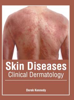 Skin Diseases