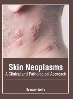 Skin Neoplasms