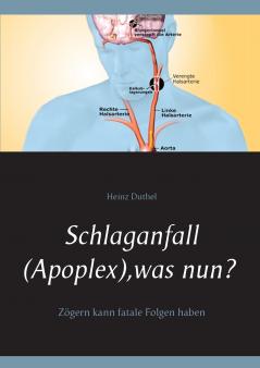 Schlaganfall (Apoplex) was nun?