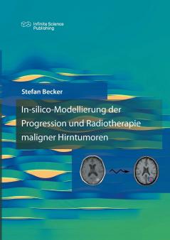 In-silico-Modellierung der Progression und Radiotherapie maligner Hirntumoren