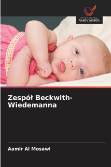 Zespół Beckwith-Wiedemanna