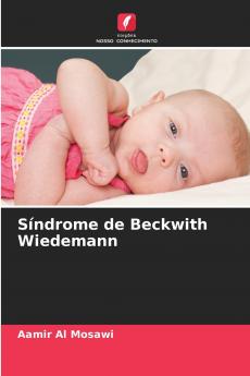 Síndrome de Beckwith Wiedemann