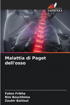 Malattia di Paget dell'osso