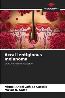 Acral lentiginous melanoma