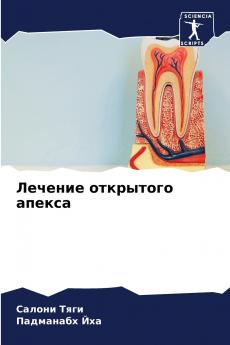 Лечение открытого апекса