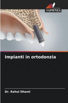 Impianti in ortodonzia