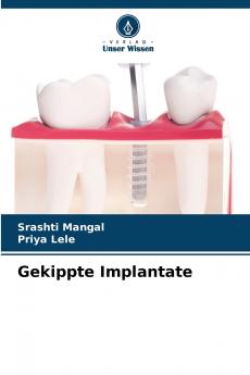 Gekippte Implantate