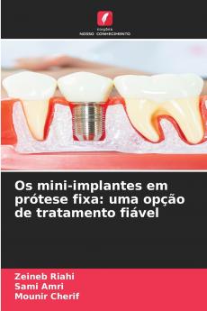 Os mini-implantes em prótese fixa