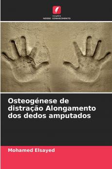 Osteogénese de distração Alongamento dos dedos amputados