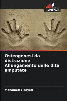 Osteogenesi da distrazione Allungamento delle dita amputate
