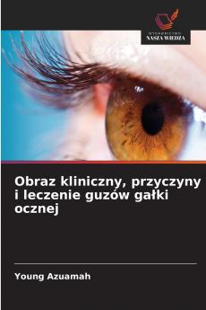 Obraz kliniczny przyczyny i leczenie guzów ga?ki ocznej