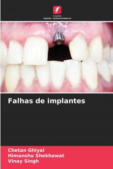Falhas de implantes