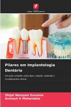 Pilares em Implantologia Dentária