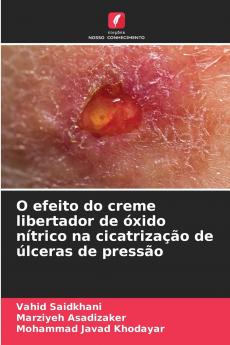 O efeito do creme libertador de óxido nítrico na cicatrização de úlceras de pressão