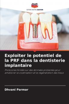 Exploiter le potentiel de la PRF dans la dentisterie implantaire