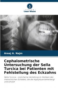 Cephalometrische Untersuchung der Sella Turcica bei Patienten mit Fehlstellung des Eckzahns